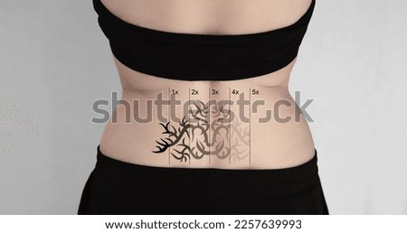 Rear View Of Laser Tattoo Removal On Woman's Hip Royalty-Free Stock Photo #2257639993
