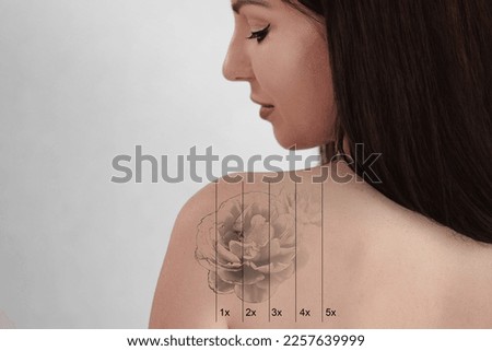 Laser Tattoo Removal On Woman's Shoulder. Medical Treatment Royalty-Free Stock Photo #2257639999