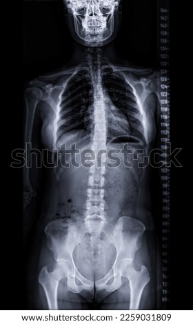X-ray image of Whole  Spine  for diagnosis scoliosis of spine. Royalty-Free Stock Photo #2259031809