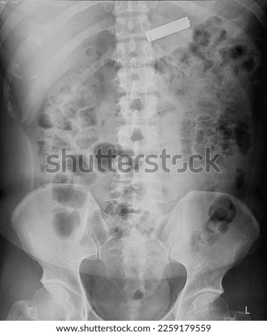 Abdominal X-ray showing radiopaque foreign body in the bowel.  Royalty-Free Stock Photo #2259179559