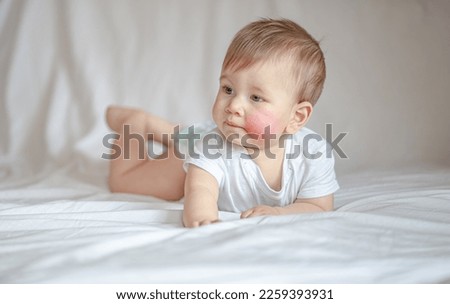 Atopic dermatitis eczema in baby.Condition that causes the skin to become red,dry,sore,itchy and cracked.Atopic eczema most often affects face in children. London England UK,Mart 30 2020 Royalty-Free Stock Photo #2259393931