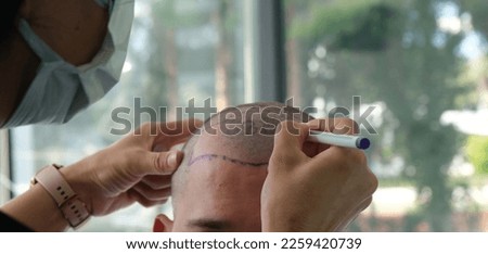 doctor check before hair transplant Royalty-Free Stock Photo #2259420739