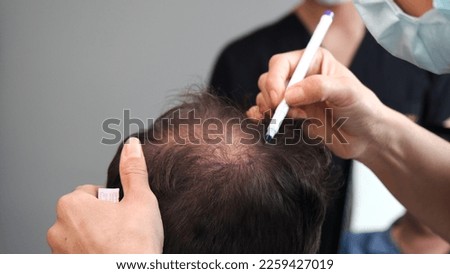 doctor check before hair transplant Royalty-Free Stock Photo #2259427019