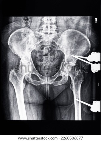 x-ray of pelvic with external fixation device fixed in femur and pelvic bones