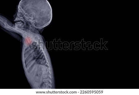 X-ray image of a 2-3 year old boy swallowing a coin stuck in his throat side view, blue tone, black background
