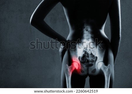 Human hip joint in x-ray on gray background. Painful hip joint is highlighted by red color. X-ray image of painful hip in woman. Osteoarthritis left hip joint at red area mark. Royalty-Free Stock Photo #2260642519