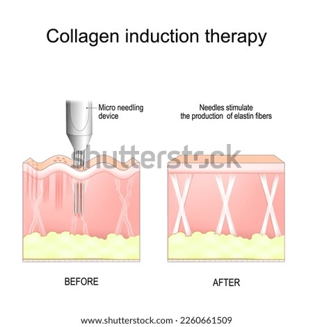 Collagen induction therapy. microneedling. skin needling procedure for remove wrinkles, scars, stretch, marks, pigmentation. repeatedly puncturing the skin with tiny sterile needle. Vector poster Royalty-Free Stock Photo #2260661509
