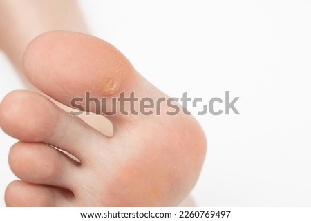 Wart on the big toe. Plantar wart on foot. Foot with corns, calluses, verrucas Royalty-Free Stock Photo #2260769497