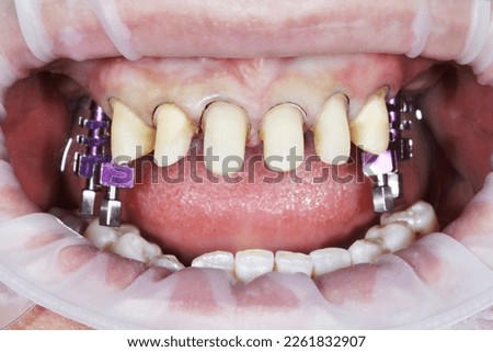 Mouth of young scary woman with yellow bad teeth smiling looking at camera. Teeth sharpened by dentist before installing crowns and ceramic veneers. Dentistry treatment, prosthetics of teeth concept Royalty-Free Stock Photo #2261832907