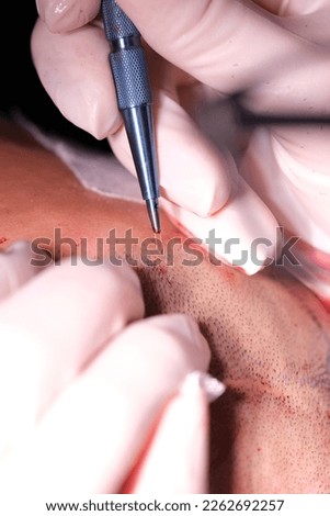 hair transplant fue sapphire  hair care Royalty-Free Stock Photo #2262692257