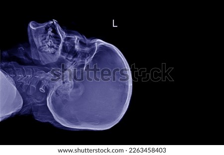 Very good quality X-ray image of the field of view. and the side (side) view is processed in a monochromatic blue tone on a black background.