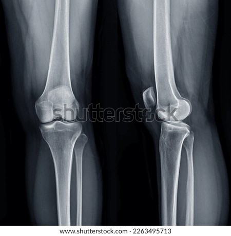 Film x-ray  of Left knee joint  AP and Lateral view  for diagnosis knee pain from osteoarthritis knee  and fracture . Royalty-Free Stock Photo #2263495713