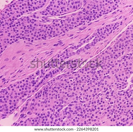 Cutaneous nodule (biopsy). Photomicrograph of glomangioma of skin. Microscopically show solid and syncytial proliferation of round cells, necrosis and nuclear atypia present. Glomus tumor. Royalty-Free Stock Photo #2264398201