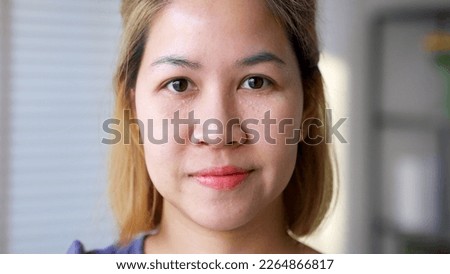 Syringoma milia milium cysts or seborrheic keratosis on asia people female face body care. Close-up young adult asian woman under eye small acne liver spot skin issue smile with pride look at camera. Royalty-Free Stock Photo #2264866817