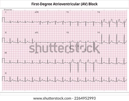 First Degree Atrioventricular Block - ECG Paper 12 Lead - Electrocardiogram - Vector Medical Illustration Royalty-Free Stock Photo #2264952993