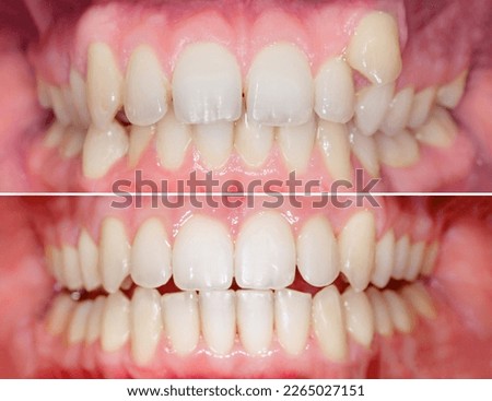 Complete smile makeover from crooked teeth to well aligned smile. Before after after using aligners invisalign or brackets Royalty-Free Stock Photo #2265027151