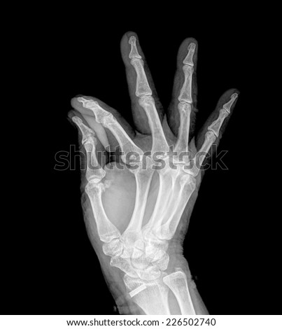 Radiography of the right hand making a gesture