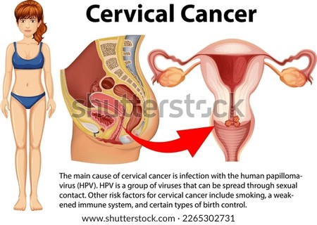 Cervical cancer infographic with explanation illustration