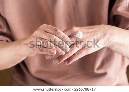 Applying ointment to hands with atopic dermatitis, eczema, allergy Royalty-Free Stock Photo #2265788717
