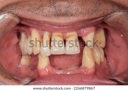 Dental front view of an adult man occlusion teeth arches. Tooth parodontal recession decay pathology on anterior sector incisors and canines, lost upper lateral incisal, lower incisors and premolars. Royalty-Free Stock Photo #2266879867