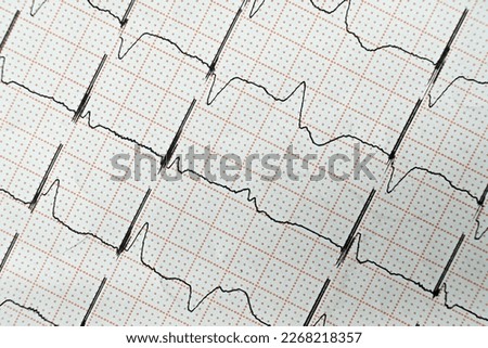 Pacemaker ECG with a ventricular extrasystole Royalty-Free Stock Photo #2268218357