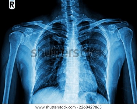 X-ray images of the shoulder show future right shoulder Royalty-Free Stock Photo #2268429865