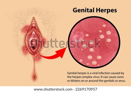 Genital Herpes infographic with explanation illustration Royalty-Free Stock Photo #2269170957