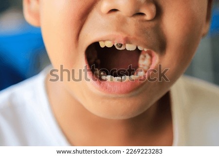 kid showing decayed tooth from eating too much candy. health care living life concept. selective focus.