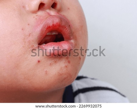 Red spot on mouth Hand foot and mouth disease of kid Herpangina disease HFMD  of infection skin disease sickness rash skin Royalty-Free Stock Photo #2269932075