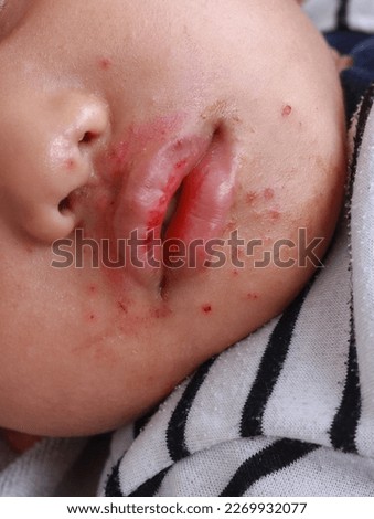 Red bumps on mouth facial dermatitis Hand foot and rash skin mouth disease of kid Herpangina disease HFMD virus infection urticaria close up  dermatology child Royalty-Free Stock Photo #2269932077