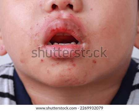 close up dermatitis Hand foot and rash Red bumps on mouth facial  skin mouth disease of Asian kid Herpangina disease HFMD virus infection urticaria Royalty-Free Stock Photo #2269932079
