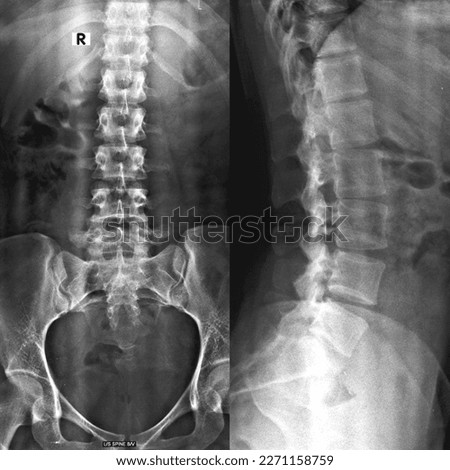 A lumbosacral spine x-ray is a picture of the small bones (vertebrae) in the lower part of the spine. This area includes the lumbar region and the sacrum, the area that connects the spine to the pelvi