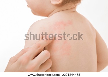 Young adult mother finger pointing to red rash on infant back. Baby boy isolated on light gray background. Allergy from food, milk formula or mother milk. Skin problem. Closeup. Royalty-Free Stock Photo #2271644455