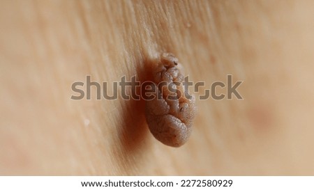 Close up - A harmless polypoid outgrowth, also known as a skin tag or acrochordon, grows close to the armpit of a male patient. Hangs from a small stalk or peduncle. Royalty-Free Stock Photo #2272580929