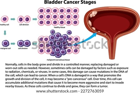 Informative Bladder Cancer Stages illustration