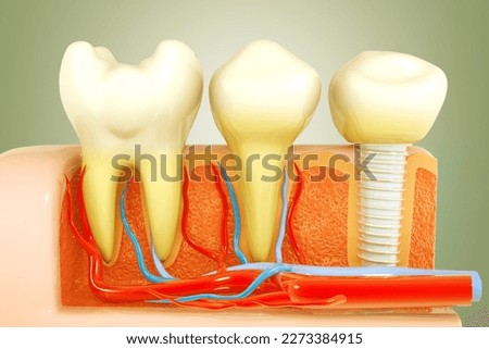 Dental implant, tooth implant, Human teeth or dentures, surgery, 3d illustration