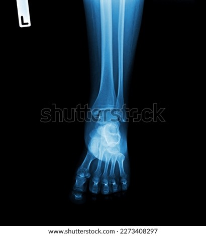 X-ray normal human of foot . Royalty-Free Stock Photo #2273408297