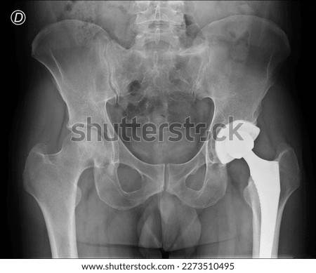 pelvis with hips in internal rotation and left hip prosthesis Royalty-Free Stock Photo #2273510495