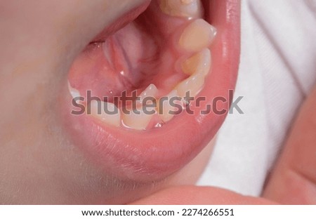 A child's tooth grows second next to the milk teeth. Formation of the jaw and permanent teeth in children. Removal of milk teeth. Royalty-Free Stock Photo #2274266551