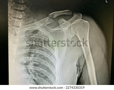 Fracture mid-shaft clavicle, trauma patient Royalty-Free Stock Photo #2274330319