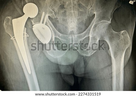 Right hip dislocation after THA Royalty-Free Stock Photo #2274331519