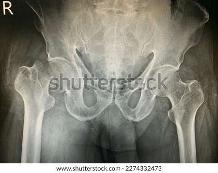 Fracture right neck of femur, before surgery Royalty-Free Stock Photo #2274332473