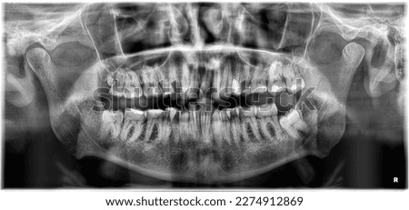 Panoramic Dental X-ray picture - 35 years old male have fourth molar on left side, rare dental condition - most of tooths is with a fillings