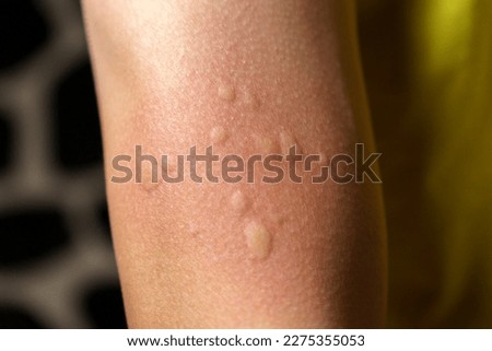 Skin texture, allergy shot, weeds, reaction Allergy symptoms Selective focus Royalty-Free Stock Photo #2275355053