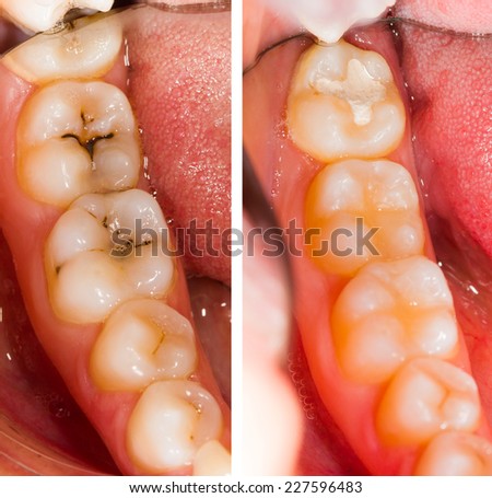 Before and after dental treatment - beforeafter series. Royalty-Free Stock Photo #227596483