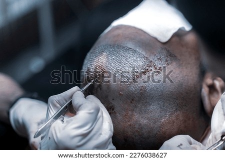 FUE hair Transplant Patient in Clinic. Hair transplant patient in the end of the operation. frequent and firm hair transplantation Royalty-Free Stock Photo #2276038627
