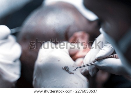FUE hair Transplant Patient in Clinic. Hair transplant patient in the end of the operation. frequent and firm hair transplantation Royalty-Free Stock Photo #2276038637