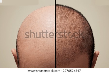 The head of a balding man before and after hair transplant surgery. Man before after hair loss treatment. Head balding man before after hair.  Royalty-Free Stock Photo #2276526347
