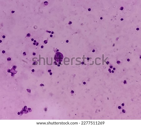 Ascetic fluid cytology, microscopically show lymphocytes, neutrophils accasional histiocytes, background show proteinaceous material. No malignant cell seen.