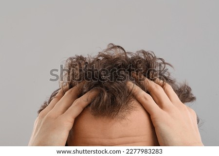 Young man with hair loss problem on grey background, closeup Royalty-Free Stock Photo #2277983283